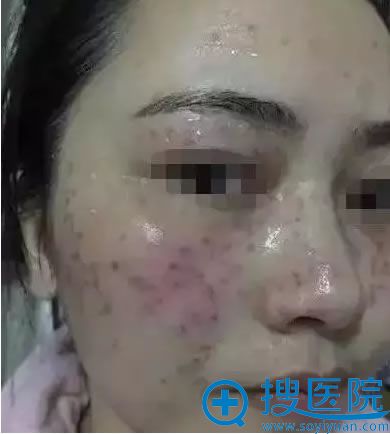 在蚌埠美莱整形医院祛斑术前照 在蚌埠美莱整形医院祛斑术前照