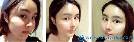 俪侬黄永勇自体脂肪面部填充术后2天效果图 俪侬黄永勇自体脂肪面部填充术后2天效果图