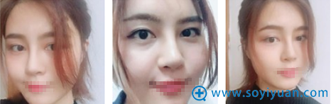 <!--<i data=20240710 data-id=9118></i>-->黄永勇脂肪填充术后24天恢复效果 <!--<i data=20240710 data-id=9118></i>-->黄永勇脂肪填充术后24天恢复效果