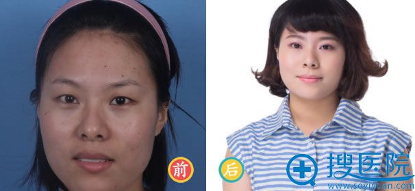 广州紫馨<!--<i data=20240710 data-id=16530></i>-->开眼角真实案例效果 广州紫馨<!--<i data=20240710 data-id=16530></i>-->开眼角真实案例效果