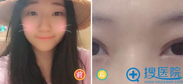 广州紫馨易东风开眼角案例效果 广州紫馨易东风开眼角案例效果