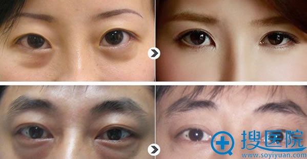 华美无痕去眼袋案例对比效果 华美无痕去眼袋案例对比效果