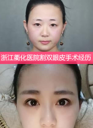 浙江衢化医院割双眼皮手术经历告诉你这个整形科怎么样
