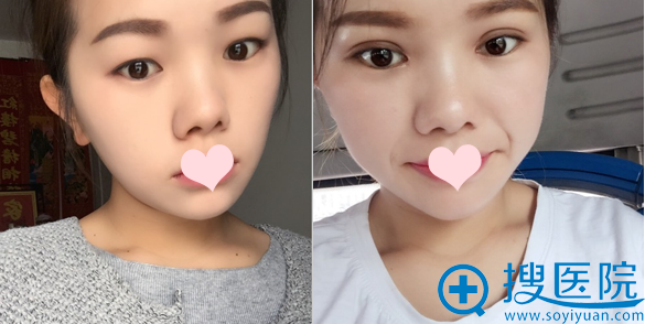 上海华安整形外科双眼皮案例 上海华安整形外科双眼皮案例