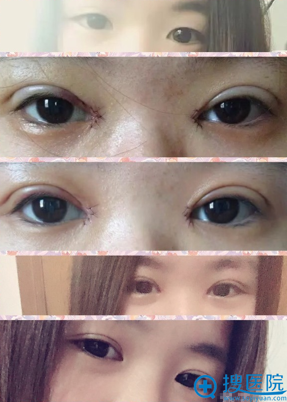 上海华安整形外科孙妹主任双眼皮案例 上海华安整形外科孙妹主任双眼皮案例