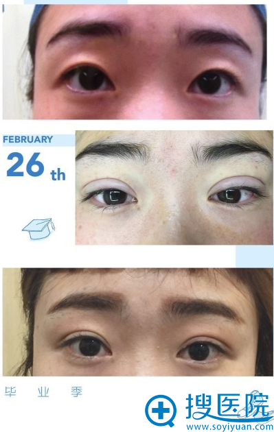 上海华安整形外科孙医生双眼皮案例 上海华安整形外科孙医生双眼皮案例
