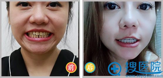 <!--<i data=20240710 data-id=12607></i>-->自然无痕隐形矫正案例 <!--<i data=20240710 data-id=12607></i>-->自然无痕隐形矫正案例