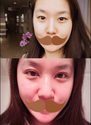 合肥韩美闫品行切开双眼皮5天恢复效果和对比案例