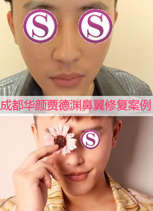 男人鼻翼左右两侧不对称怎么办 成都华颜贾德渊鼻翼修复案例