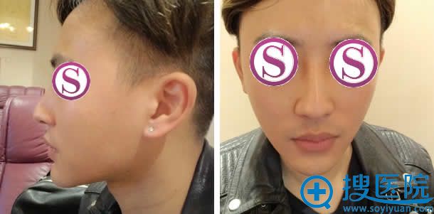男人鼻失败鼻翼不对称照片 男人鼻失败鼻翼不对称照片
