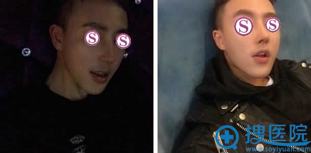 鼻翼鼻尖修复手术17天照片 鼻翼鼻尖修复手术17天照片
