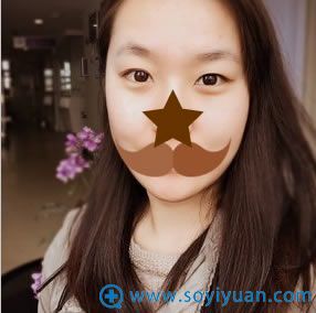在合肥韩美整形医院做双眼皮术前照 在合肥韩美整形医院做双眼皮术前照