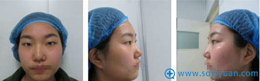 郑州丽天整形罗明生全切双眼皮案例恢复过程图片大分享