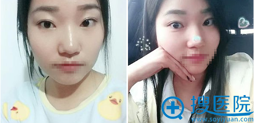 郑州丽天整形罗明生全切双眼皮48天恢复效果 郑州丽天整形罗明生全切双眼皮48天恢复效果