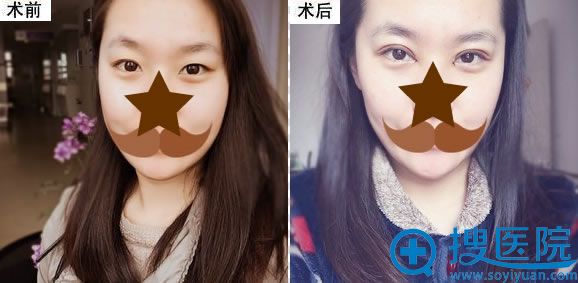 合肥韩美闫品行双眼皮前后对比案例 合肥韩美闫品行双眼皮前后对比案例