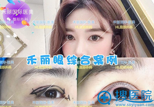 武汉禾丽医疗美容医院眼综合案例 武汉禾丽医疗美容医院眼综合案例