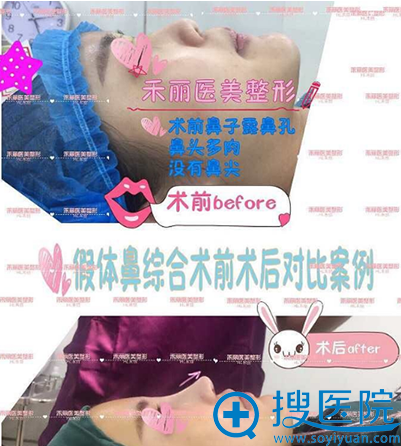 武汉禾丽医疗美容医院假体鼻综合案例 武汉禾丽医疗美容医院假体鼻综合案例