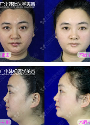 在广州韩妃医学美容医院体验面部线雕提升手术全部过程