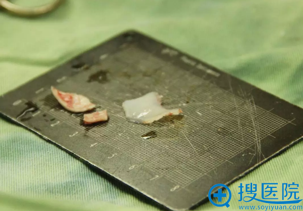 提取出的耳软骨+鼻中隔软骨 提取出的耳软骨+鼻中隔软骨