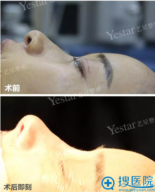 bsk宫廷隆鼻术后即效果对比 bsk宫廷隆鼻术后即效果对比