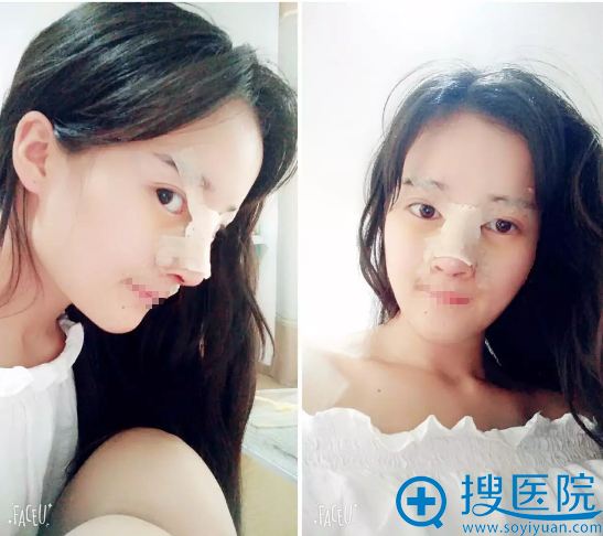 bsk宫廷隆鼻第5天图片 bsk宫廷隆鼻第5天图片