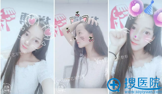 bsk宫廷隆鼻术后半个月生活照 bsk宫廷隆鼻术后半个月生活照
