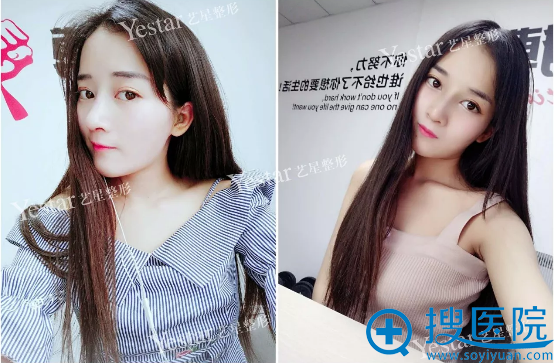 bsk宫廷隆鼻术后30天的样子 bsk宫廷隆鼻术后30天的样子