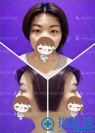 南京安安整形医生毕金刚双眼皮案例恢复期图片公开
