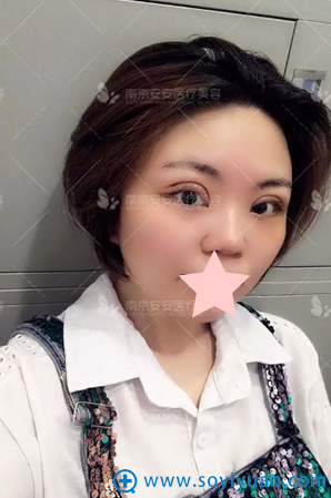 <!--<i data=20240710 data-id=12337></i>-->整形毕金刚双眼皮术后一周恢复图片 <!--<i data=20240710 data-id=12337></i>-->整形毕金刚双眼皮术后一周恢复图片