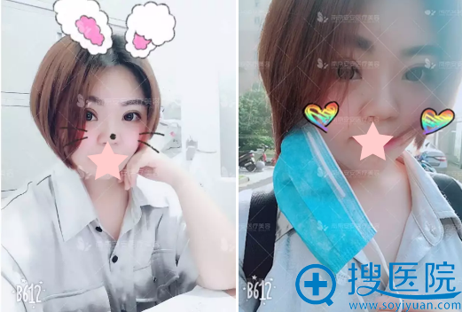 <!--<i data=20240710 data-id=12337></i>-->整形医生毕金刚双眼皮手术后一个月效果 <!--<i data=20240710 data-id=12337></i>-->整形医生毕金刚双眼皮手术后一个月效果