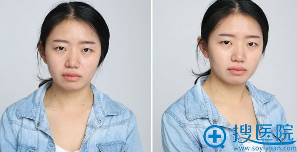 在长沙雅美医疗美容医院做眼整形术前照 在长沙雅美医疗美容医院做眼整形术前照