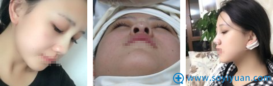 哈尔滨索菲陈富全耳软骨鼻综合术后1天效果 哈尔滨索菲陈富全耳软骨鼻综合术后1天效果