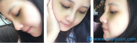 哈尔滨索菲陈富全耳软骨鼻综合拆线后青肿情况 哈尔滨索菲陈富全耳软骨鼻综合拆线后青肿情况