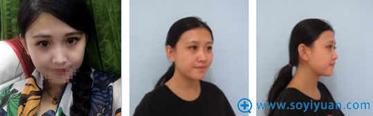 哈尔滨索菲陈富全做鼻子怎么样 耳软骨鼻综合案例真实图片分享