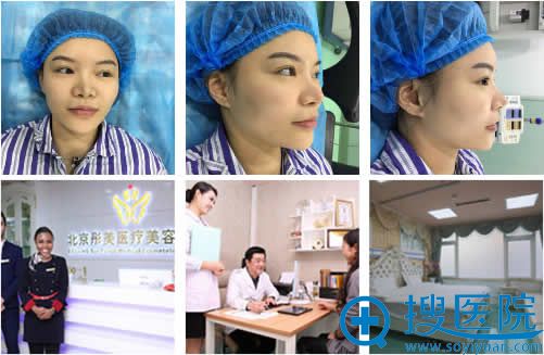 北京彤美整形医院桂行军主任做自体软骨垫鼻尖效果怎么样