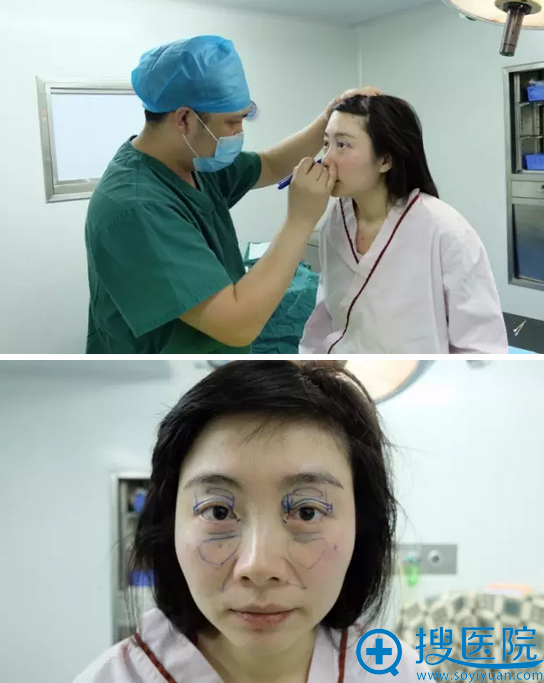 面部自体脂肪填充设计 面部自体脂肪填充设计