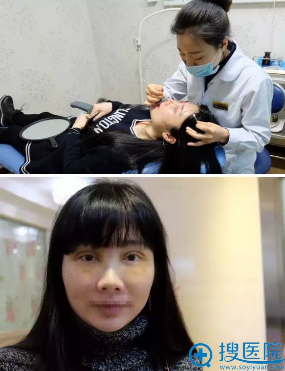 双眼皮术后天复诊 双眼皮术后天复诊