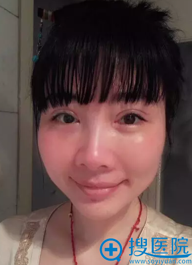 双眼皮和脂肪填充术后第8天生活照 双眼皮和脂肪填充术后第8天生活照
