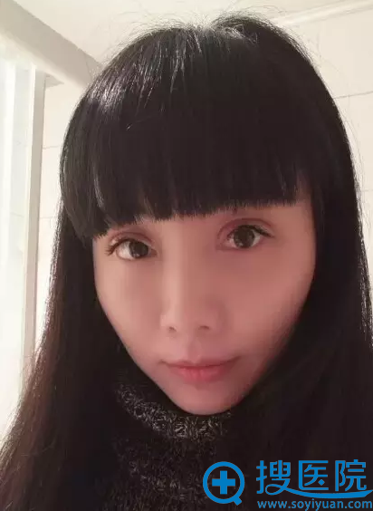 双眼皮术后15天恢复期照片 双眼皮术后15天恢复期照片