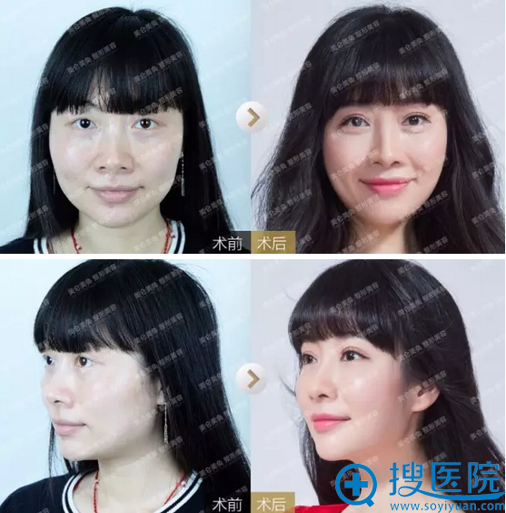 重庆美仑美奂做的自体脂肪填充全脸+双眼皮案例过程效果图分享