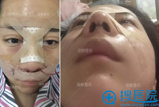 薛克乾注射隆鼻失败修复术后即刻效果 薛克乾注射隆鼻失败修复术后即刻效果