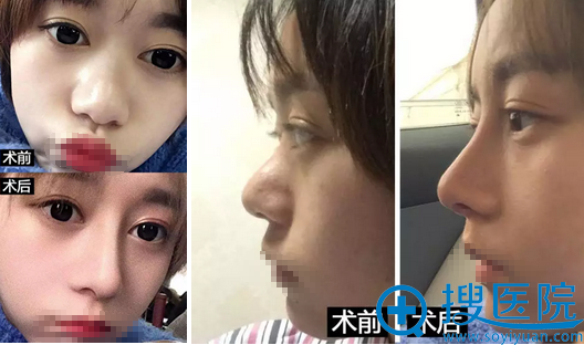 福州海峡薛克乾鼻修复术后1个月对比效果 福州海峡薛克乾鼻修复术后1个月对比效果