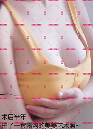 武汉美天医疗美容医院朱晓浩院长双平面假体隆乳案例