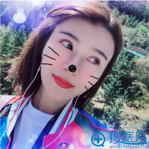 看我花6000多元找天津美莱卜胜利割的双眼皮案例效果怎么样