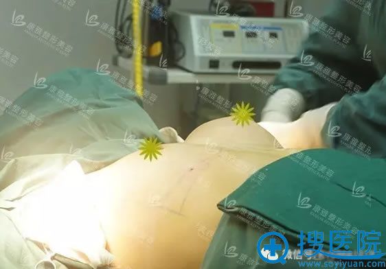 蜜桃假体隆胸做完一边时的效果对比 蜜桃假体隆胸做完一边时的效果对比