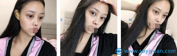 崔向葵切开双眼皮术后当天效果 崔向葵切开双眼皮术后当天效果