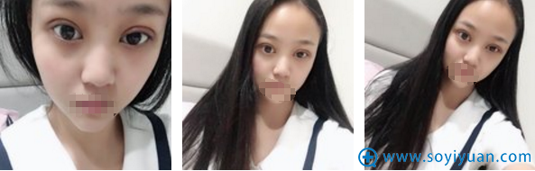 合肥崔劲松医疗美容诊所切开双眼皮术后3天 合肥崔劲松医疗美容诊所切开双眼皮术后3天