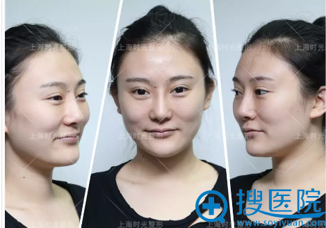 找何晋龙主任改脸型术前照 找何晋龙主任改脸型术前照