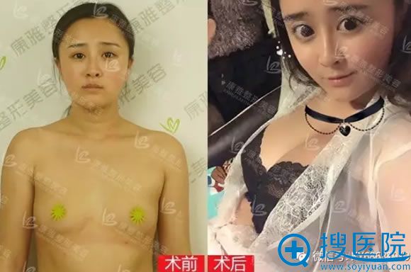 <!--<i data=20240710 data-id=12505></i>-->银山SVR蜜桃隆胸前后对比案例 <!--<i data=20240710 data-id=12505></i>-->银山SVR蜜桃隆胸前后对比案例