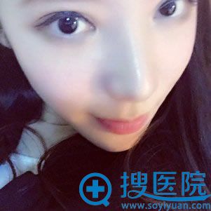 注射玻尿酸填充卧蚕前的照片 注射玻尿酸填充卧蚕前的照片
